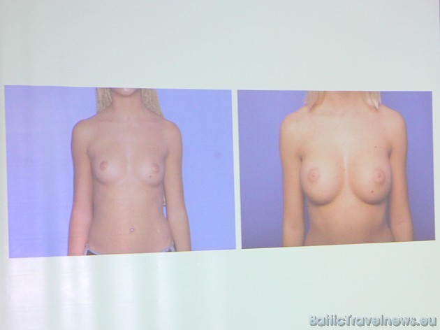Viens no plastiskās ķirurģijas uzmanības centriem ir un paliek - sieviešu krūtis 41614