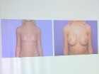Viens no plastiskās ķirurģijas uzmanības centriem ir un paliek - sieviešu krūtis 5