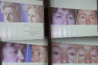 Dažādas sejas vaibstu vai grimašu korekcijas, kuras panāk bez īpašas ķirurģiskās iejaukšanās 6
